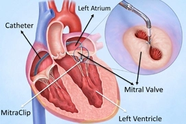 heart-valve-repair-procedure-delhi