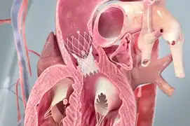 heart-valve-replacement-surgery-delhi