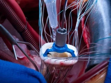 heart-valve-surgery-overview-delhi